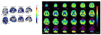 Bipolar disorder and Lewy body dementia: case report and literature review